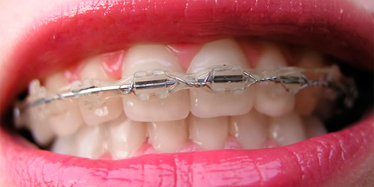 Damon Clear Braces Damon Orthdodontics