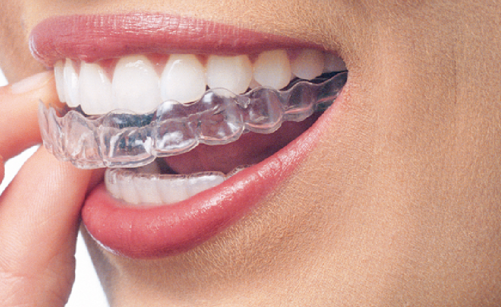 Invisalign®