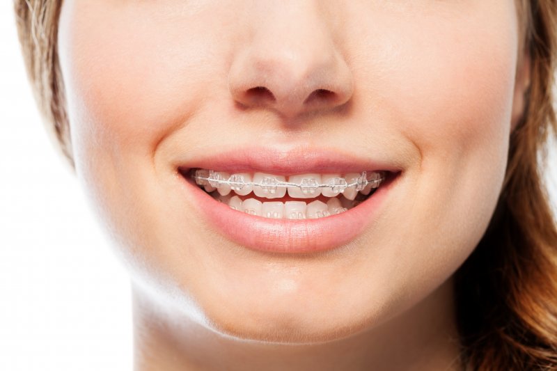 Adult Braces