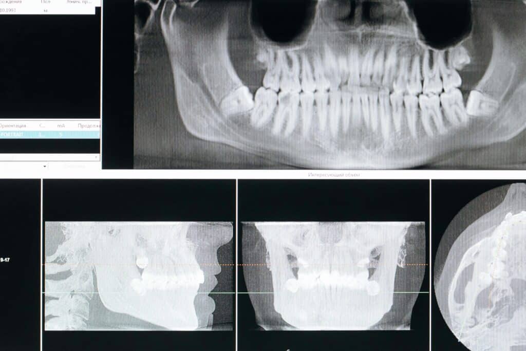 crossbite scan