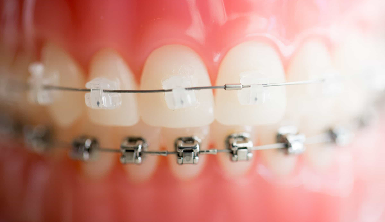 Are There Clear Braces Options? - Brimhall Dental Group Bakersfield  California